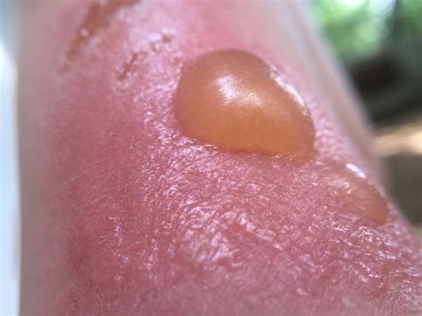 Sunburn Bubbles: What They Are & How to Treat Them